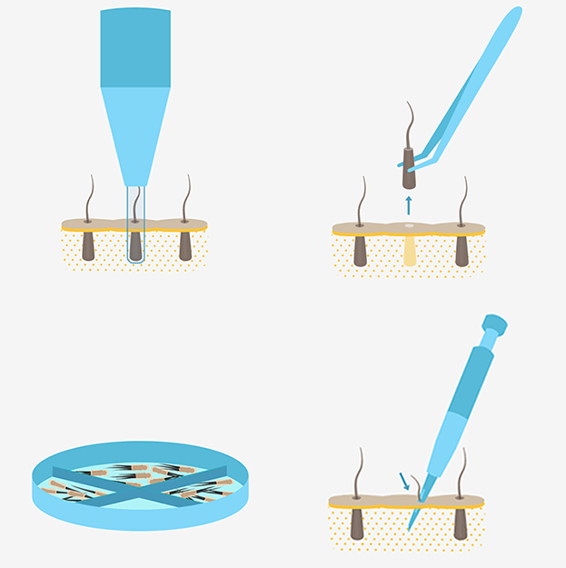 FUE-Procedure